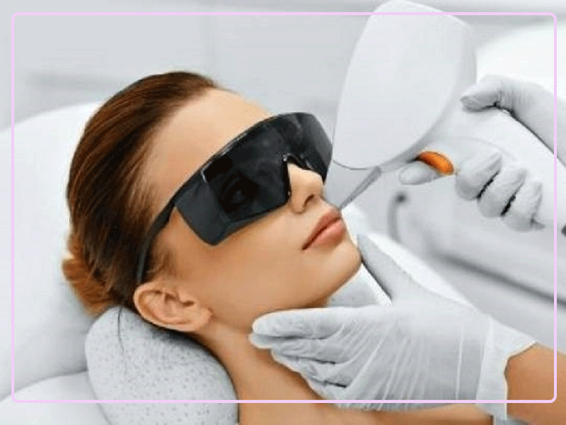 لیزر-موهای-زائد