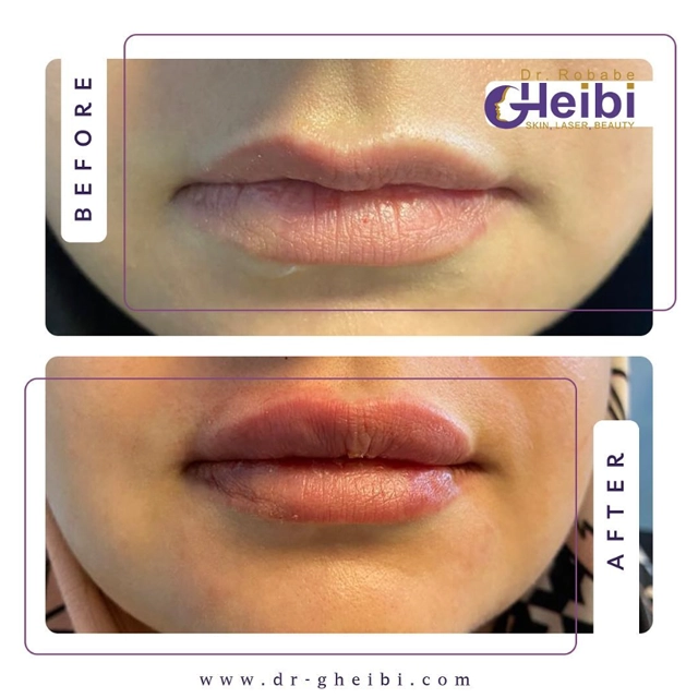 نمونه کار تزریق ژل لب