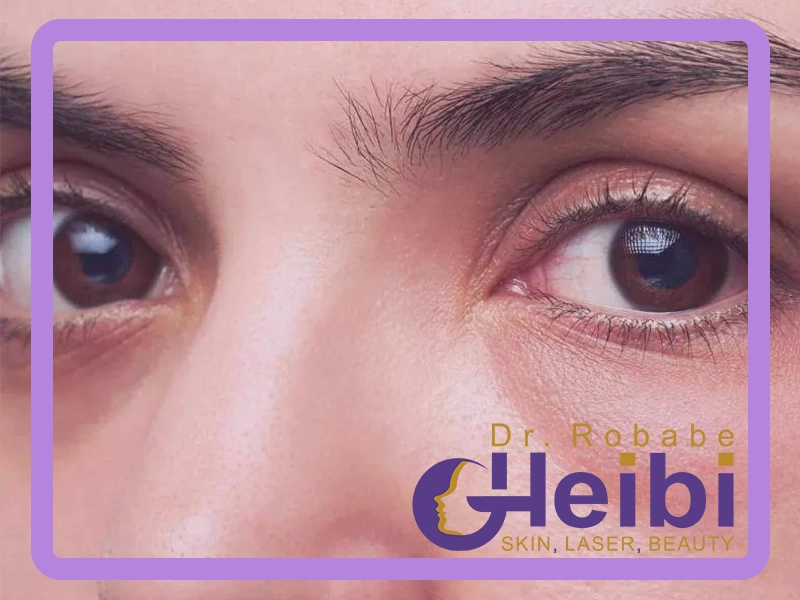 بلفاروپلاستی در تهران