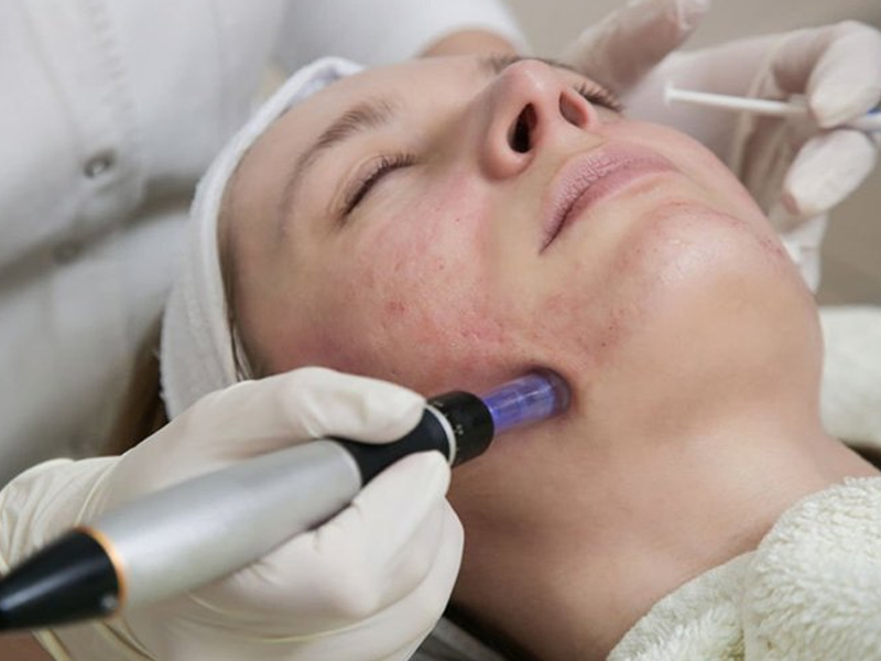 میکرونیدلینگ صورت