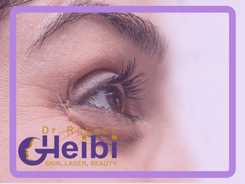 رفع تیرگی چشم