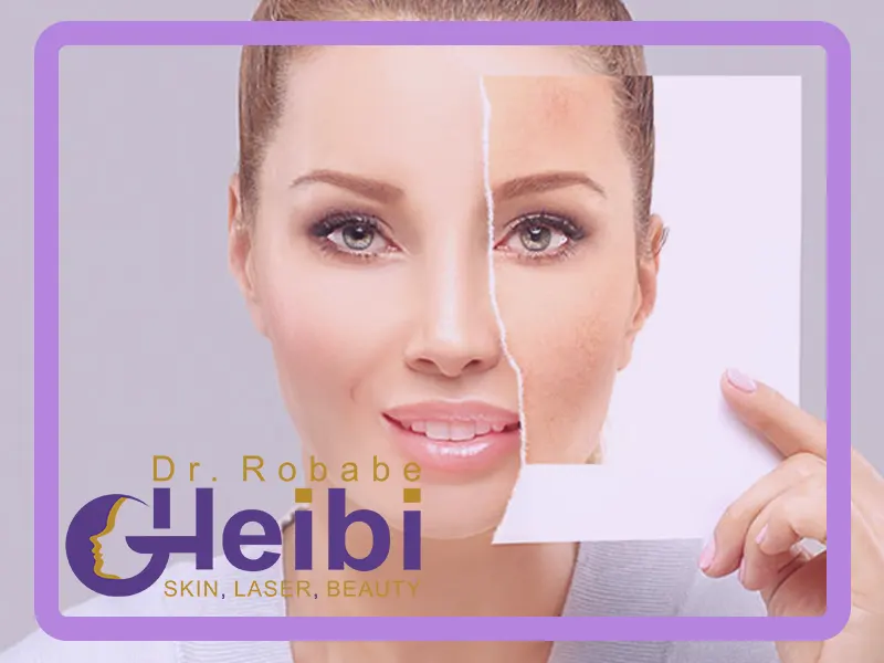 میکرودرم ابریژن صورت