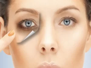 هایفوگرافی دور چشم