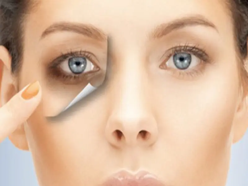 هایفوگرافی دور چشم