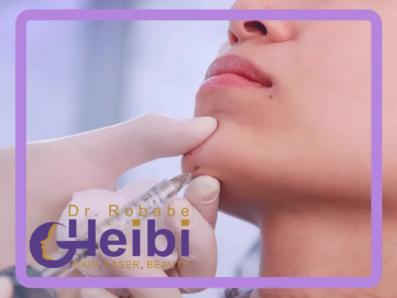 زاویه سازی فک با فیلر