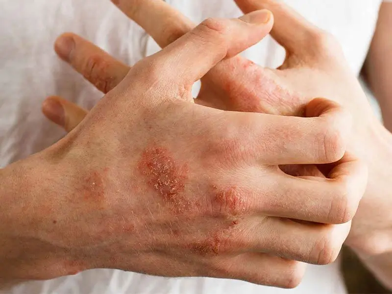 درمان اختلال پسوریازیس