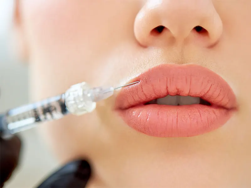 تزریق ژل لب روسی
