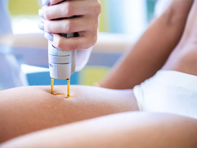 لیزر موهای زائد بیکینی