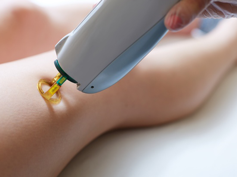 مراقبت بعد از لیزر موهای زائد