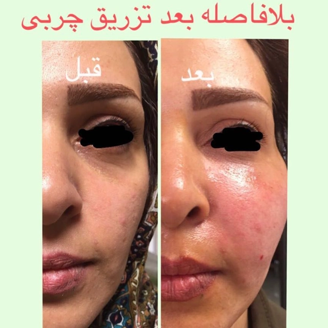 بلفاصله بعداز تزریق چربی به صورت توسط دکتر ربابه غیبی