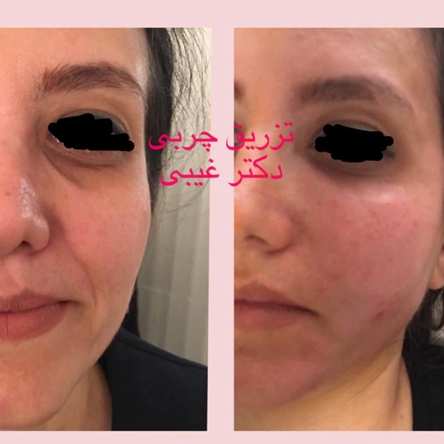 تزریق چربی به صورت برای چه کسانی مناسب است؟