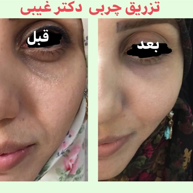 نمونه کار تزریق چربی به دکتر دکتر ربابه غیبی