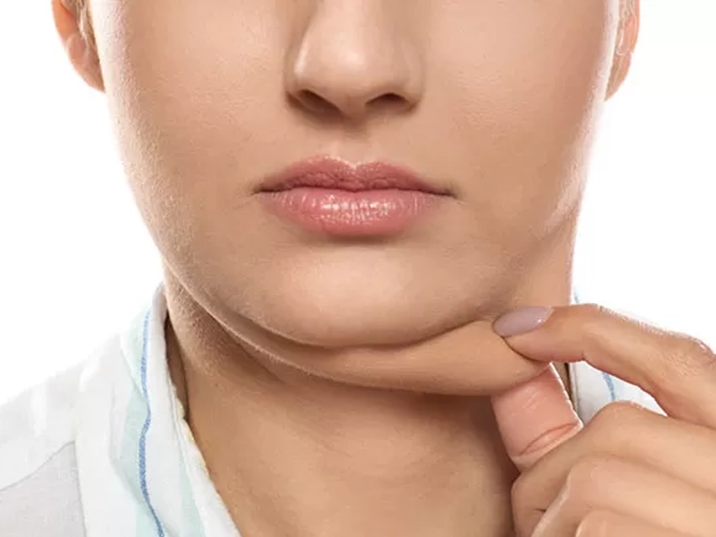 اندولیفت غبغب