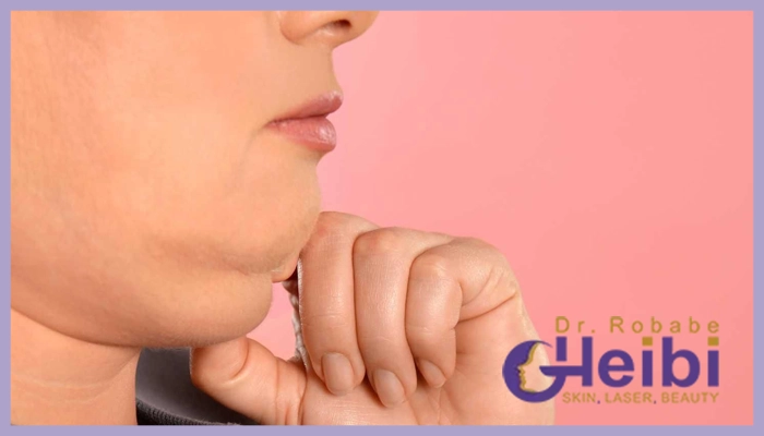 مدت زمان ماندگاری اندولیفت غبغب چقدر است؟