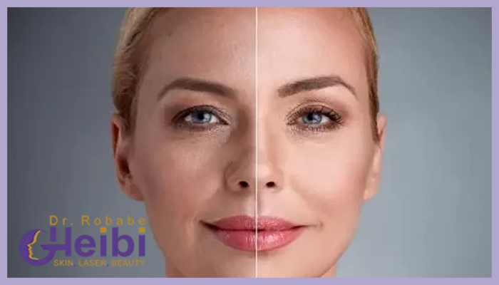 درمان ورم بعد از اندولیفت