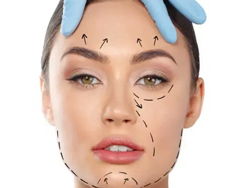 مزایای لیفت صورت با نخ