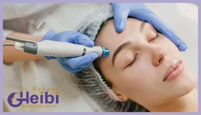 تا چه زمانی مراقبت های بعد از میکرونیدلینگ باید رعایت کنیم؟