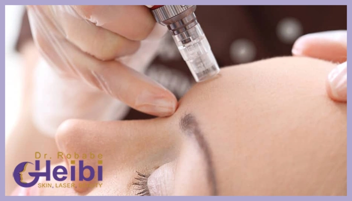 ماندگاری میکرونیدلینگ چقدر است؟