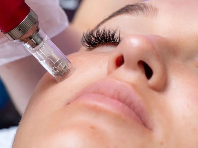 مدت زمان ماندگاری میکرونیدلینگ