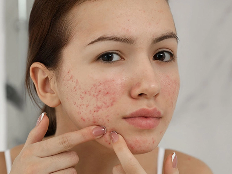 بهترین روش درمان آکنه