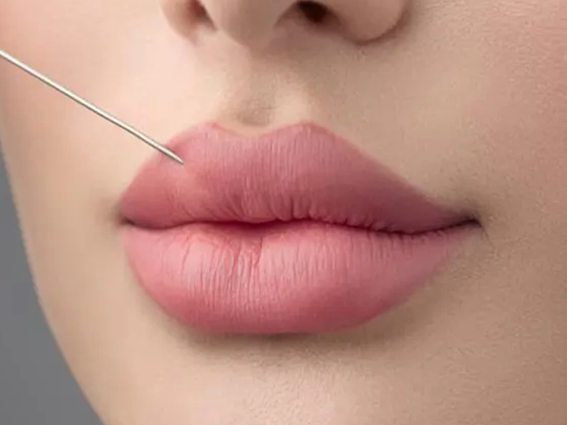 تزریق ژل لب + نمونه کار واقعی