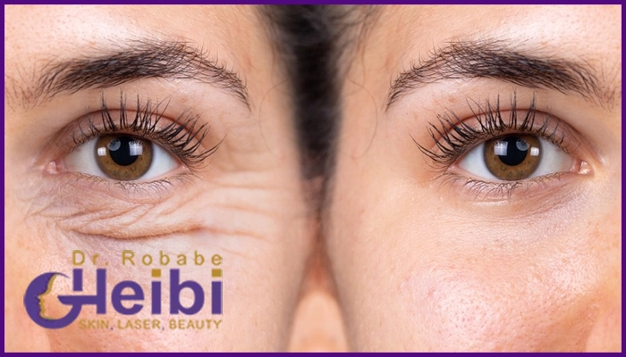 مزایای تزریق چربی زیر چشم