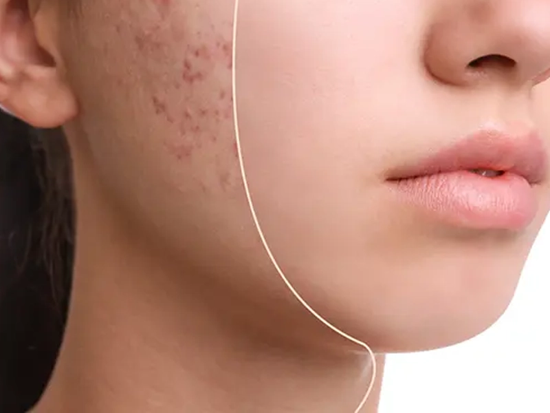 اندولیفت جای جوش