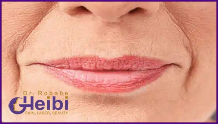 اندولیفت خط خنده چیست؟