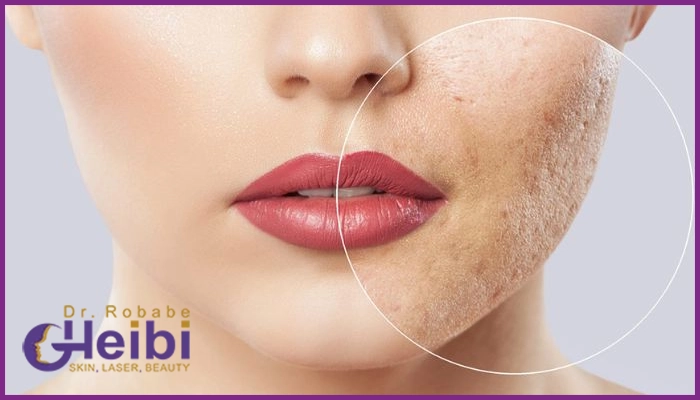 مراحل انجام اندولیفت جای جوش