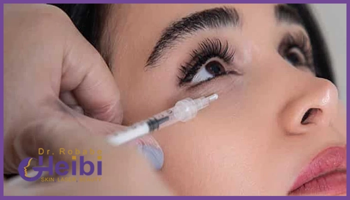 مزوتراپی زیر چشم برای چه کسانی مناسب است؟